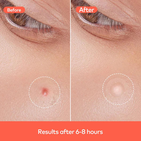 Pimple Patches – Hydrocolloid & Tea Tree Oil for Acne | GlowForm
